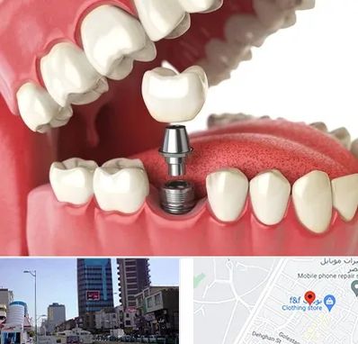 متخصص پروتز دندان در چهارراه طالقانی کرج