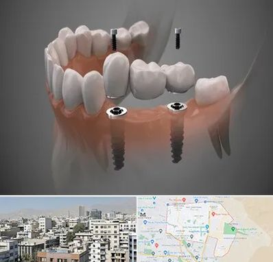 ایمپلنت دیجیتال در منطقه 14 تهران