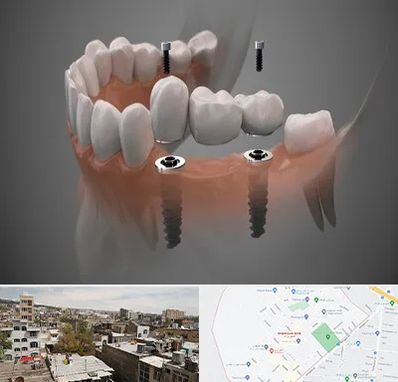 ایمپلنت دیجیتال در شمیران نو