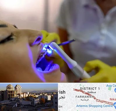 دندانپزشکی با لیزر در فرمانیه 