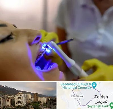دندانپزشکی با لیزر در زعفرانیه 