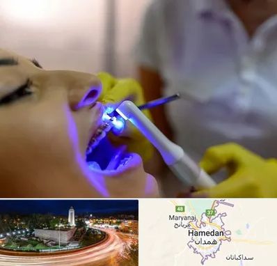 دندانپزشکی با لیزر در همدان