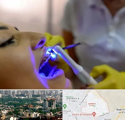 دندانپزشکی با لیزر در عظیمیه کرج 