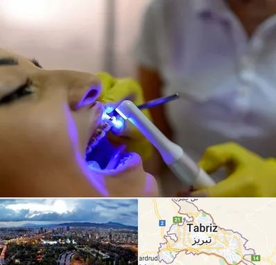 دندانپزشکی با لیزر در تبریز