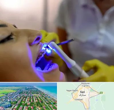 دندانپزشکی با لیزر در ساری