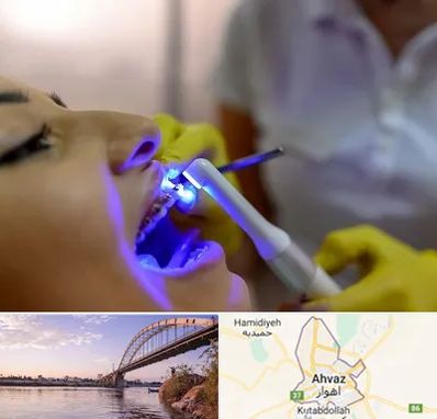 دندانپزشکی با لیزر در اهواز
