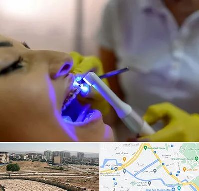 دندانپزشکی با لیزر در کوی وحدت شیراز