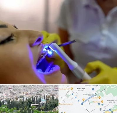 دندانپزشکی با لیزر در محلاتی شیراز