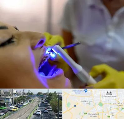 دندانپزشکی با لیزر در جنوب تهران 