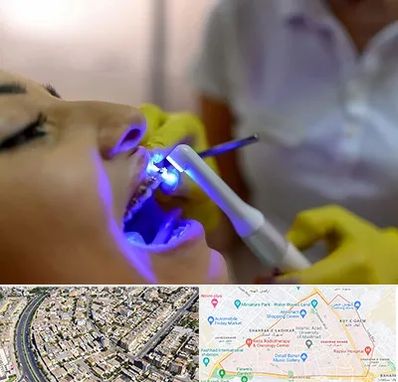 دندانپزشکی با لیزر در شهرک غرب مشهد