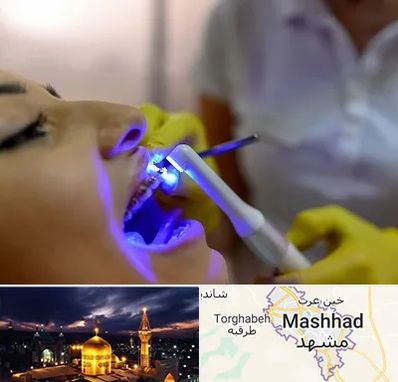 دندانپزشکی با لیزر در مشهد
