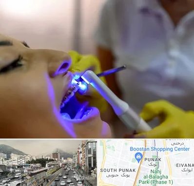 دندانپزشکی با لیزر در پونک 