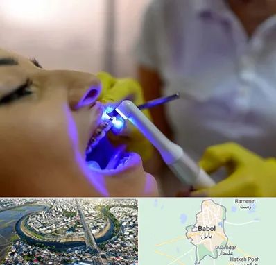 دندانپزشکی با لیزر در بابل