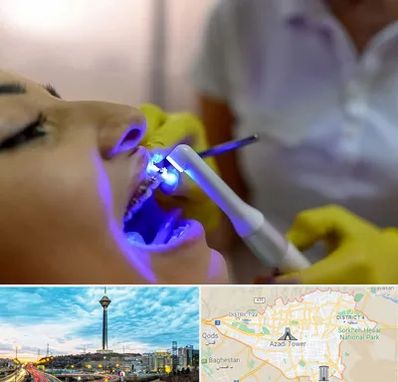 دندانپزشکی با لیزر در تهران
