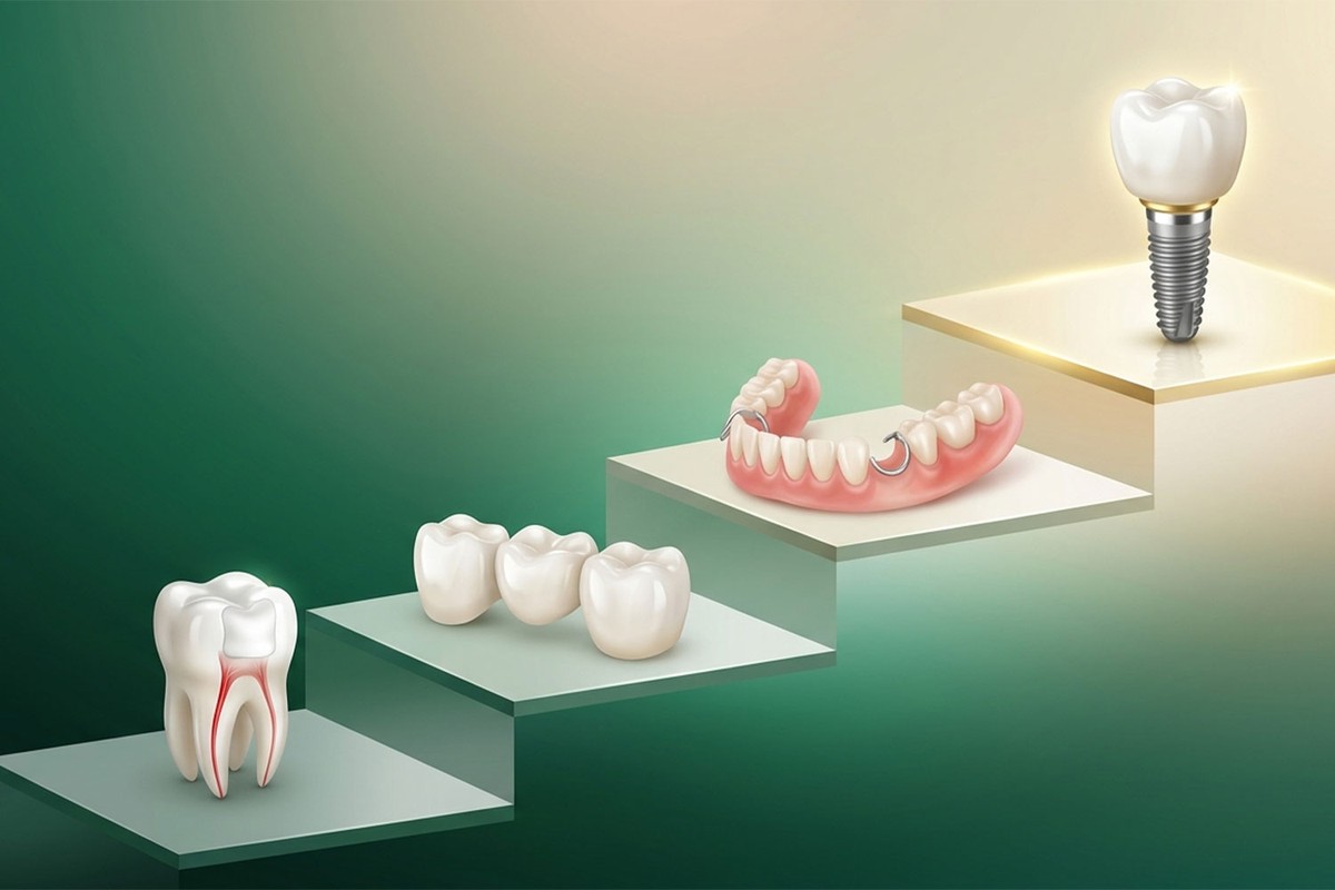 مقایسه هزینه ایمپلنت با سایر روشها | کدام روش اقتصادیتر است؟